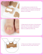 Load image into Gallery viewer, 1/5pc Non-Glue Toenail Patch Ingrown Toenail Correction Pedicure Tool Toe Inlay Nail Corrector Nail Patch Correction Stickers