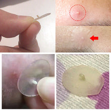 Load image into Gallery viewer, BREYLEE Acne Pimple Patch Face Mask Skin Care Acne Treatment Serum Face Cream Acne Cream Essence Sheet Mask Facial Care Tools