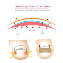 Load image into Gallery viewer, 1/5pc Non-Glue Toenail Patch Ingrown Toenail Correction Pedicure Tool Toe Inlay Nail Corrector Nail Patch Correction Stickers
