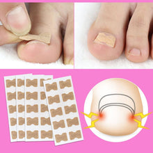 Load image into Gallery viewer, 1/5pc Non-Glue Toenail Patch Ingrown Toenail Correction Pedicure Tool Toe Inlay Nail Corrector Nail Patch Correction Stickers
