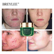 Load image into Gallery viewer, BREYLEE Acne Pimple Patch Face Mask Skin Care Acne Treatment Serum Face Cream Acne Cream Essence Sheet Mask Facial Care Tools
