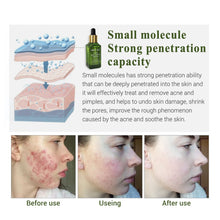 Load image into Gallery viewer, BREYLEE Acne Pimple Patch Face Mask Skin Care Acne Treatment Serum Face Cream Acne Cream Essence Sheet Mask Facial Care Tools

