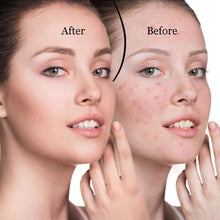 Load image into Gallery viewer, Pore Cleaner Blackhead Remover Vacuum Face Skin Care Suction Black head Black Dots Blackheads Pimples Removal Deep Cleaning Tool
